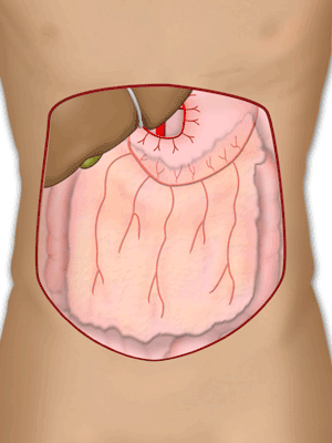 Greater Omentum